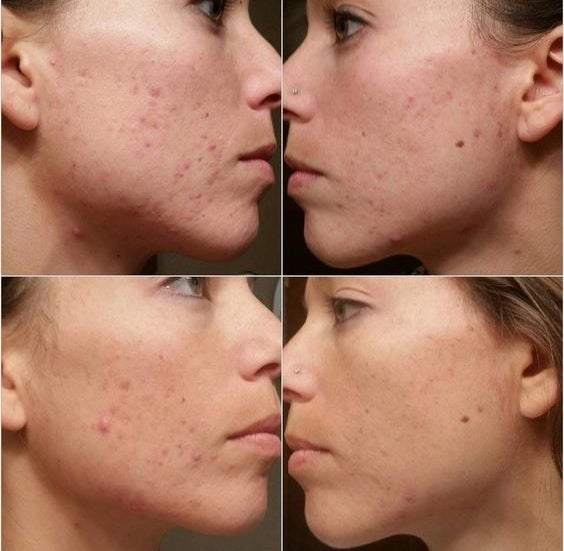 A four-paneled image of a reviewer&#x27;s acne progressing from worst to best 