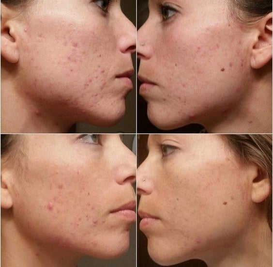 A four-paneled image of a reviewer's acne progressing from worst to best