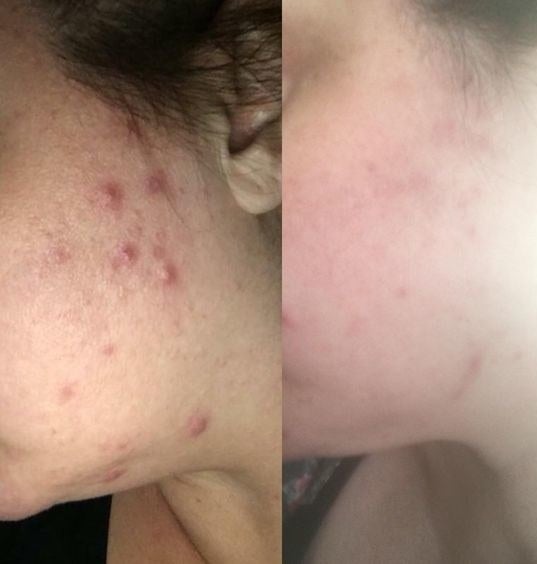 A split image showing a reviewer image of a cheek covered in cystic acne and the same cheek with significantly less acne 