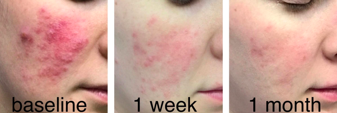 A three-paneled image showing the progressive improvement of a reviewer&#x27;s acne with each panel labeled &quot;baseline&quot;, &quot;1 week&quot;, and &quot;1 month&quot; 