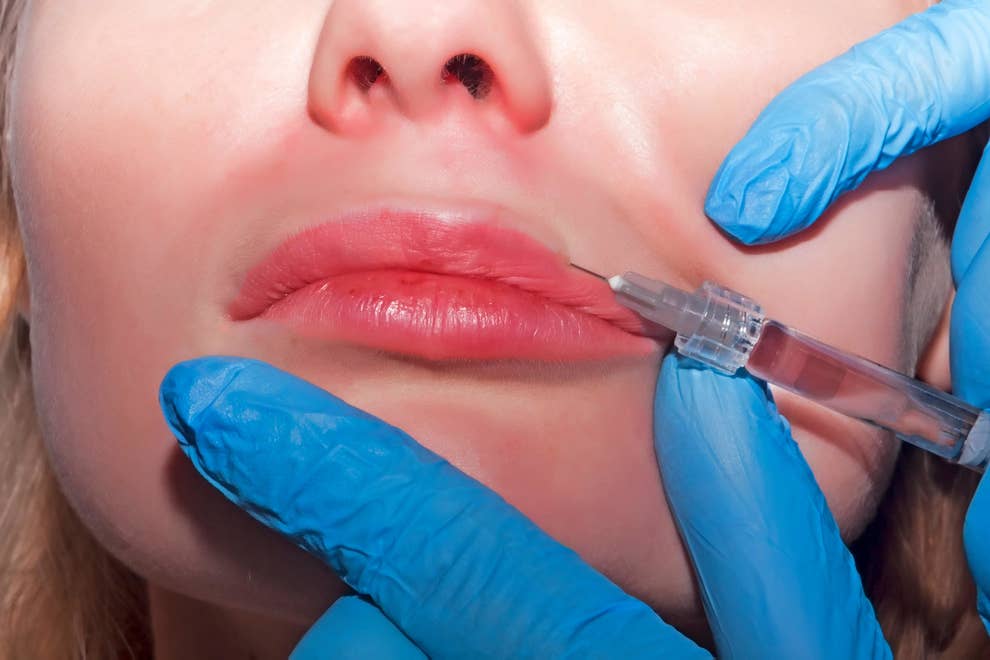 Why Fillers Are The Go To Beauty Hack For Millennials Why Fillers Are The Go To Beauty Hack For Millennials