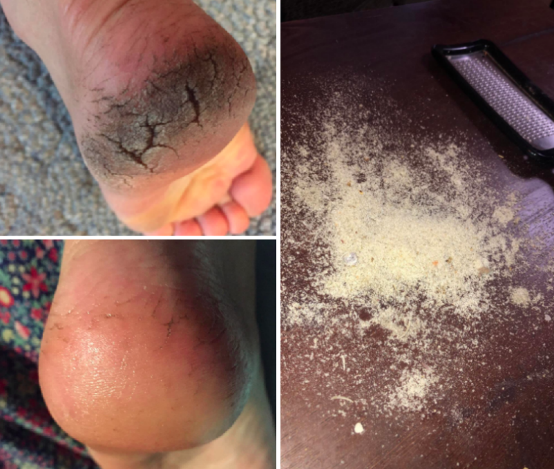 Reviewer&#x27;s before and after using the rasp, with the before photo showing severely cracked and dry feet. The after photo shows smooth, almost healed feet.