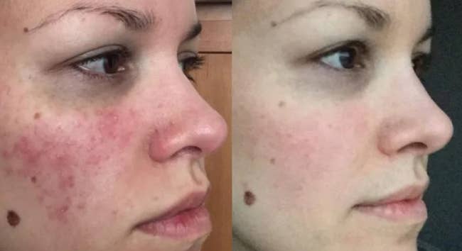 Reviewer pic of their skin before using the cream and then after