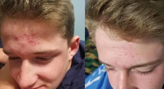 a reviewer's before and after of cystic acne on their forehead, followed by the same forehead looking noticeably clearer and smoother