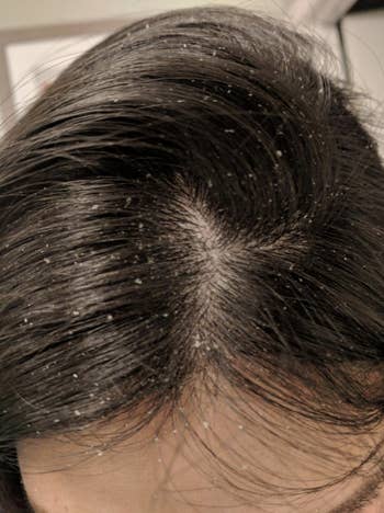 Reviewer showing dandruff in hair