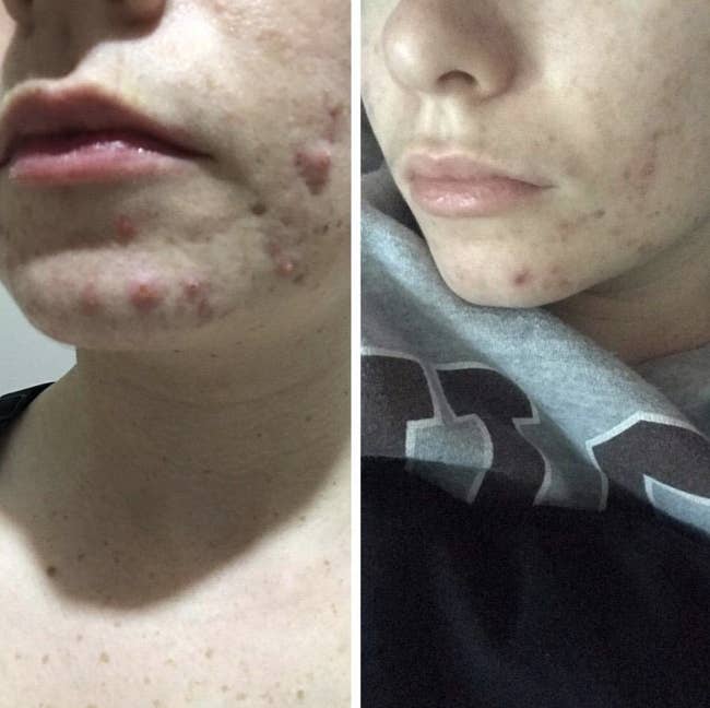 Reviewer before and after with less severe acne