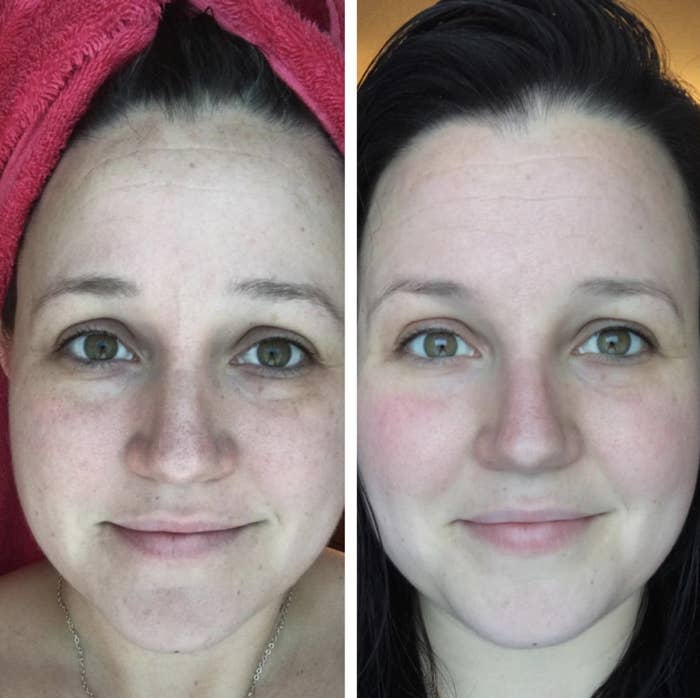 A before and after photo of a reviewer&#x27;s skin with dark visibly lightened after using the serum