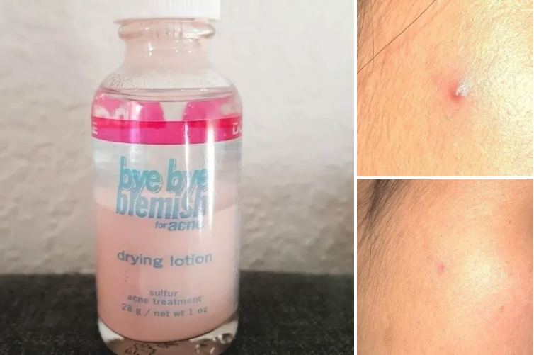 Get it from Amazon for $7.75Promising review: "I have tried almost everything as a spot treatment for acne with minimal results, but this stuff actually works. I put it on at night on my trouble spots, and by morning there is a difference. In just a few days, most of my acne has disappeared or reduced in size and redness. For the price, this stuff is magic in a bottle. You will look a little silly going to bed, but it's worth it for the results. It does have a not great smell, but it fades once it dries on your face. I would highly recommend." —Amazon Customer