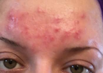 Reviewer showing severe acne