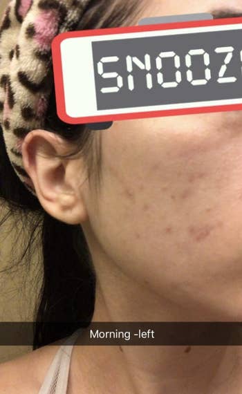Same reviewer showing less severe acne 