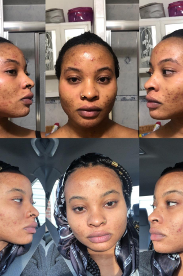10 Face Masks With Before And After Photos That Will Make You A Believer