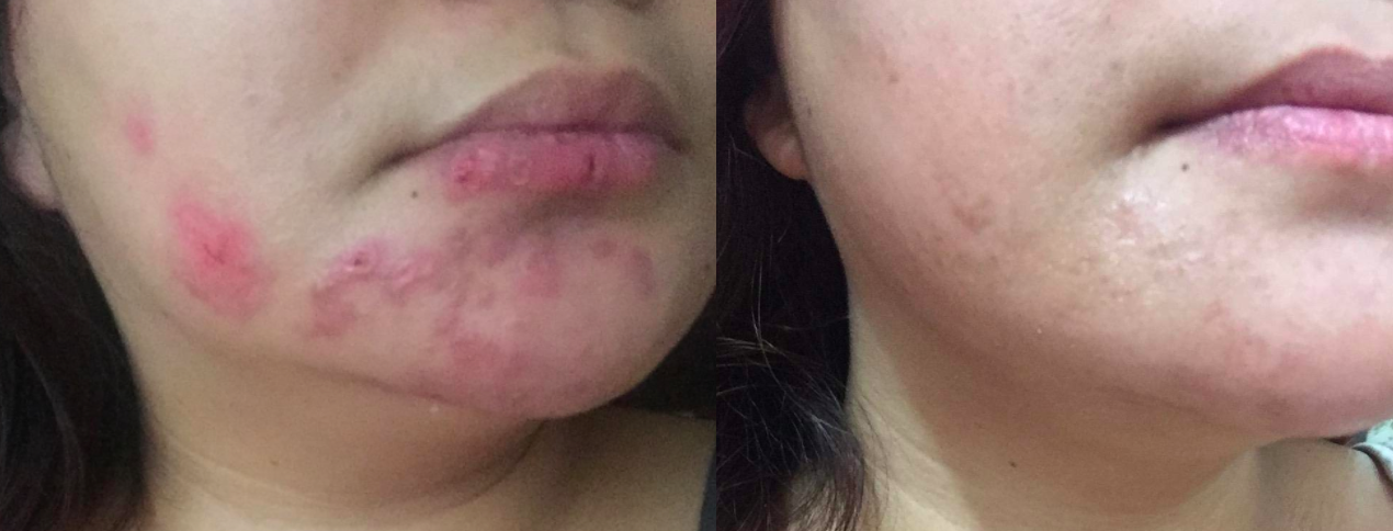 A customer review photo showing their skin before (with acne) and after (without acne) using the oil