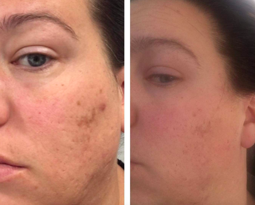 24 Products To Help You Deal With Acne Scars