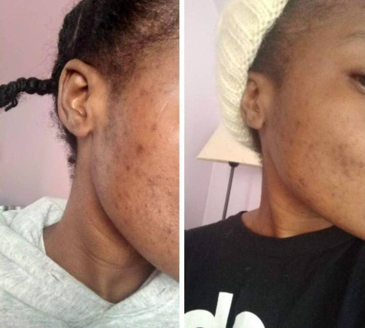 Lumin top acne scars