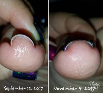 before and aft showing a reviewer's toenail present straight