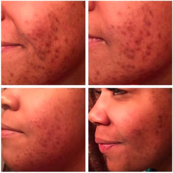 A series of customer review photos showing the results after using the Radha Beauty Rosehip Oil
