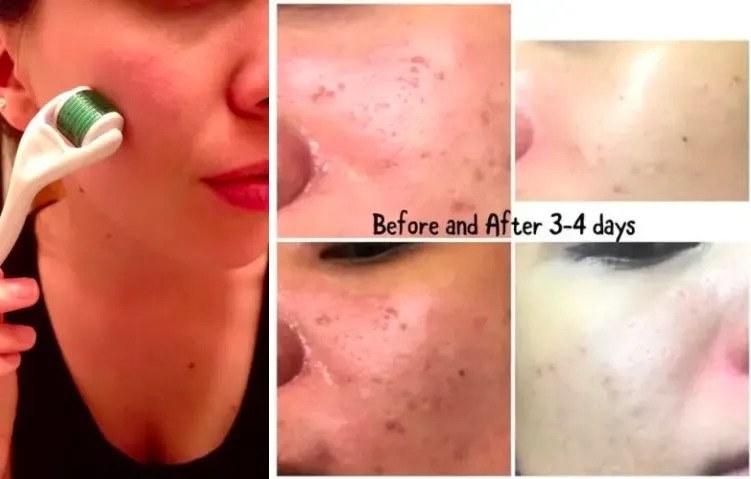 a series of reviewer photos showing one user&#x27;s results and clearer skin over time as they use the derma roller