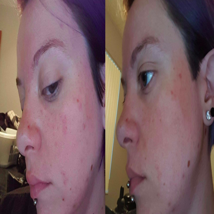 24 Products To Help You Deal With Acne Scars