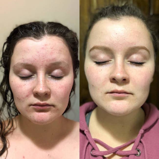 A reviewer's face before/after showing reduced acne and redness