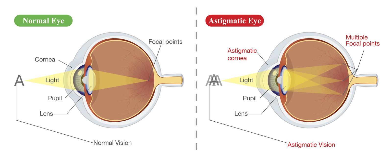 What Affects Astigmatism