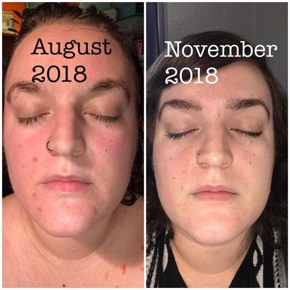 Reviewer&#x27;s before-and-after with acne on August 2018 and then clear face on November 2018 
