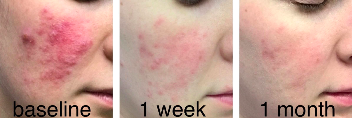 Reviewer&#x27;s dramatic before-and-after with irritated red acne and then almost totally clear skin