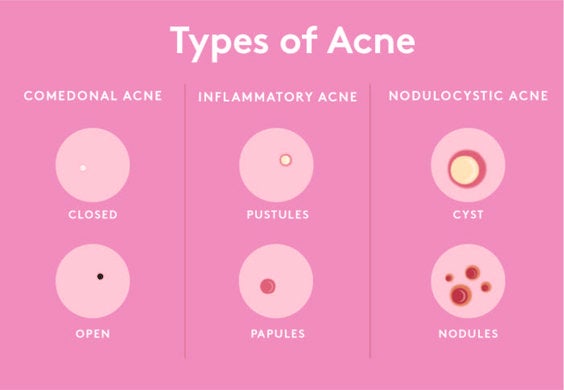 Graphic showing different types of acne: comedonal acne, inflammatory acne, nodulocystic acne