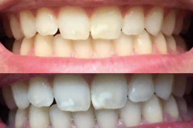 Invisalign Review I Ve Had It For Two Years And Here S Everything