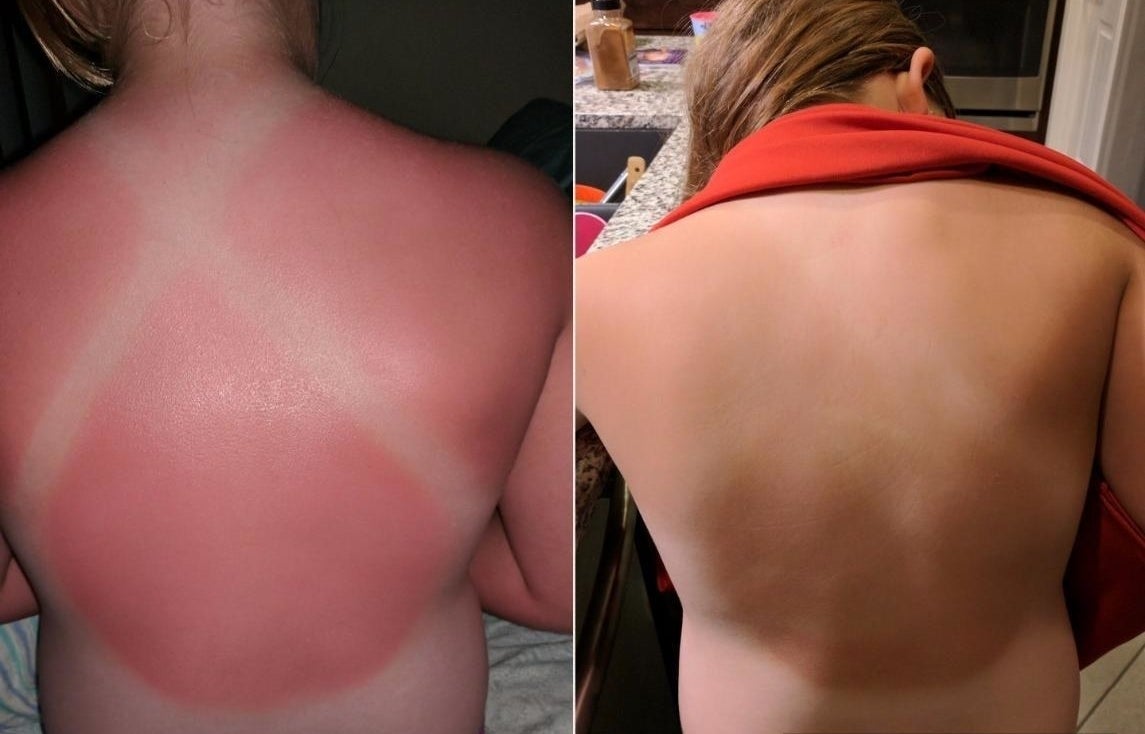 Reviewer before and after photos showing a red, sunburned back returning to normal skin tone after applying the lotion