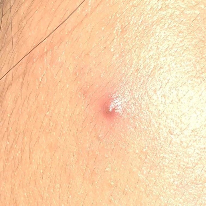 Reviewer photo showing a large and red pimple before treatment