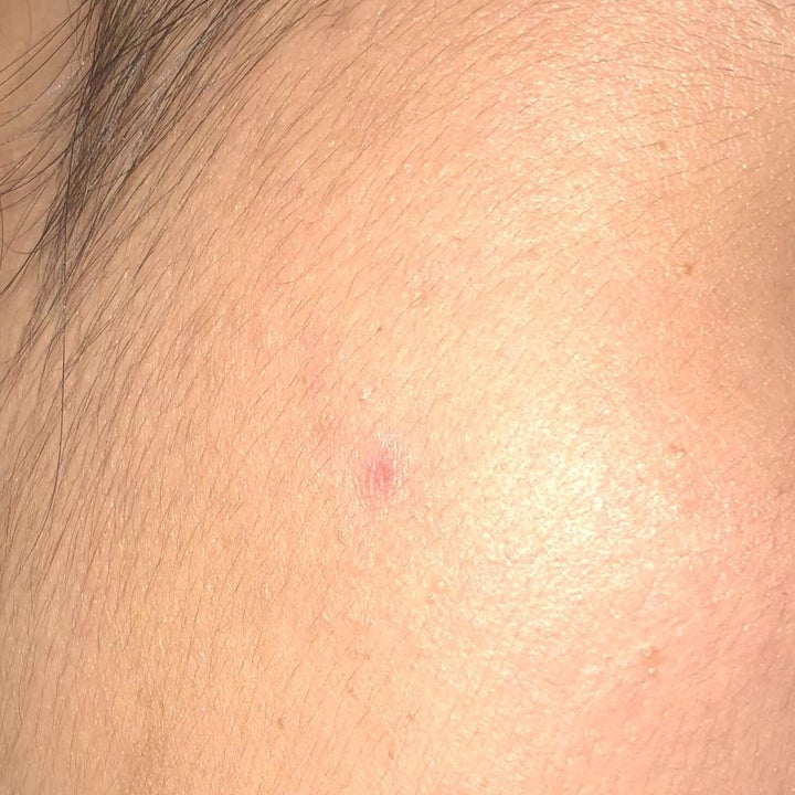 Reviewer photo showing the same pimple after treatment, which is barely noticeable and almost gone