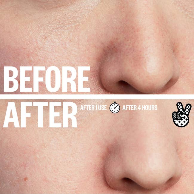 A before/after showing the difference after using the strips for four hours, with less visible pores after and fewer blackheads