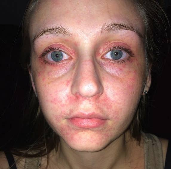 Allergic Reaction To Makeup Swollen Eyes - Mugeek Vidalondon
 Makeup Allergic Reaction