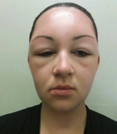 "I am allergic to the sun and mistakingly went out without a hat on. Ended up in the emergency room."—pereiraolg