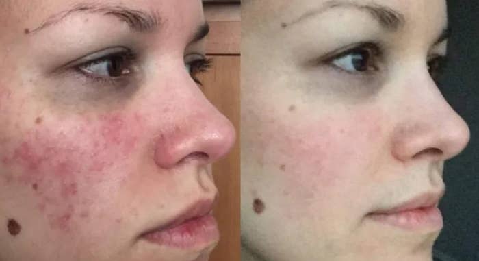A person&#x27;s face before: you see general redness all over that could be caused by dryness, and some acne especially on the cheek area. And the &quot;after&quot; photo, where their face looks clear with minimal redness