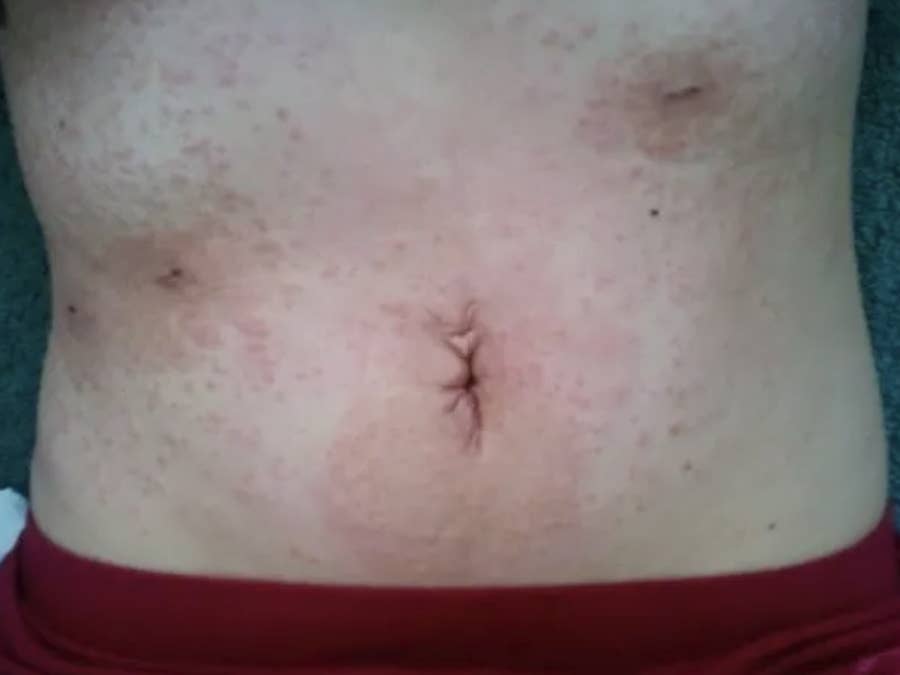 Awful heat rash in stomach fold now weeping - warning - photo