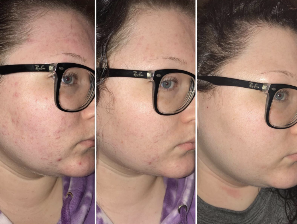 Reviewer showing progression of less acne after using the oil