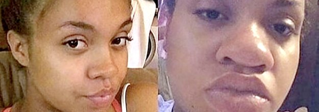 Swollen Lips Pregnancy Sign | Lipstutorial.org