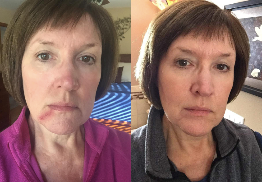 before: reviewer with scar on chin after: scar covered and hard to see
