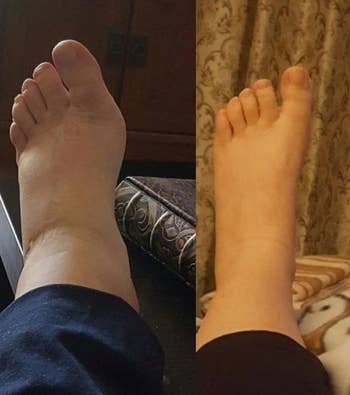 reviewer photo showing a swollen on the right, and the same food noticeably smaller on the right after wearing the compression sock 