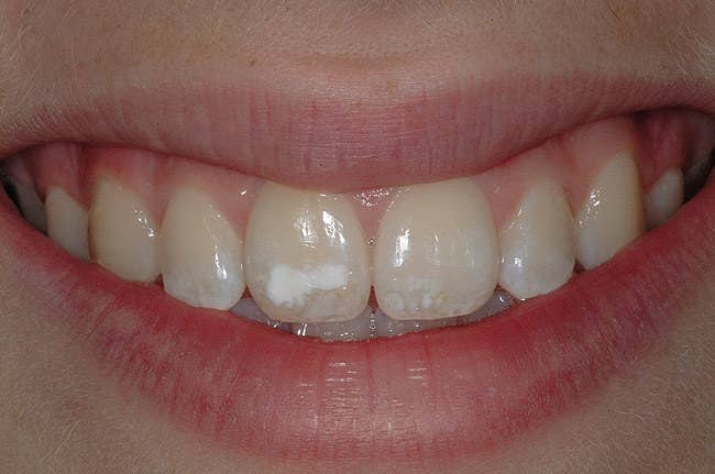 There are two types of enamel hypoplasia based on the reasons its development. The first type is hereditary enamel hypoplasia and the second type is environmental enamel hypoplasia.Hereditary enamel hypoplasia is the type of enamel underdevelopment issue which occurs as a result of genetic reasons. Generally, this type of enamel hypoplasia affects only a part of a single tooth in the mouth. However, severer cases, in which multiple teeth are affected, also exist.Enamel hypoplasia caused by environmental reasons has the same signs as those of hereditary enamel hypoplasia. Nevertheless, there can be various reasons for the development of this issue. Some of those issues include malnutrition, premature birth, viral and bacterial infections, and injury or trauma to newly developing teeth.
