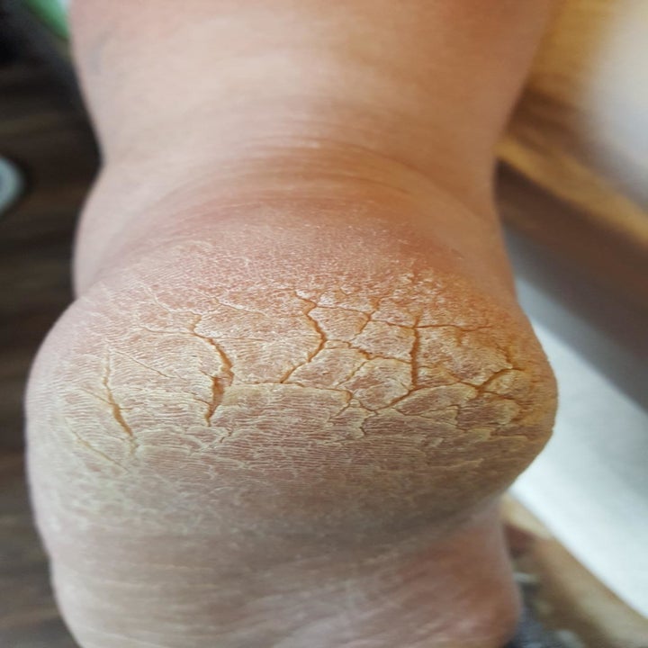 reviewer's cracked, calloused heel