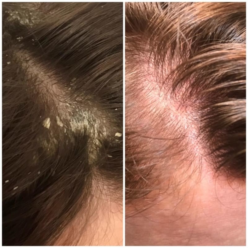 In the before photo, a close-up of a scalp with dandruff. In the after photo, the same scalp, now completely free of dandruff