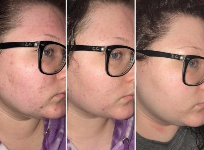 three split images tracking the progress of a reviewers red, irritated skin to their soothed, clearer skin, from using the oil