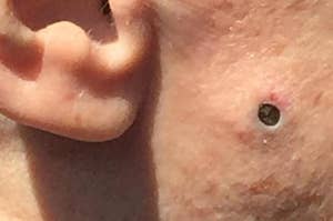 Pimple Popping
