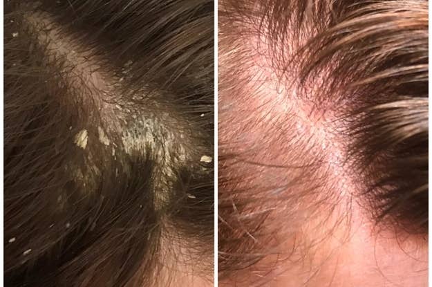 18 Things You Need To Know Before Getting Laser Hair Removal