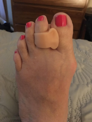 The same reviewer's foot showing the toe separator preventing the overlap from occuring
