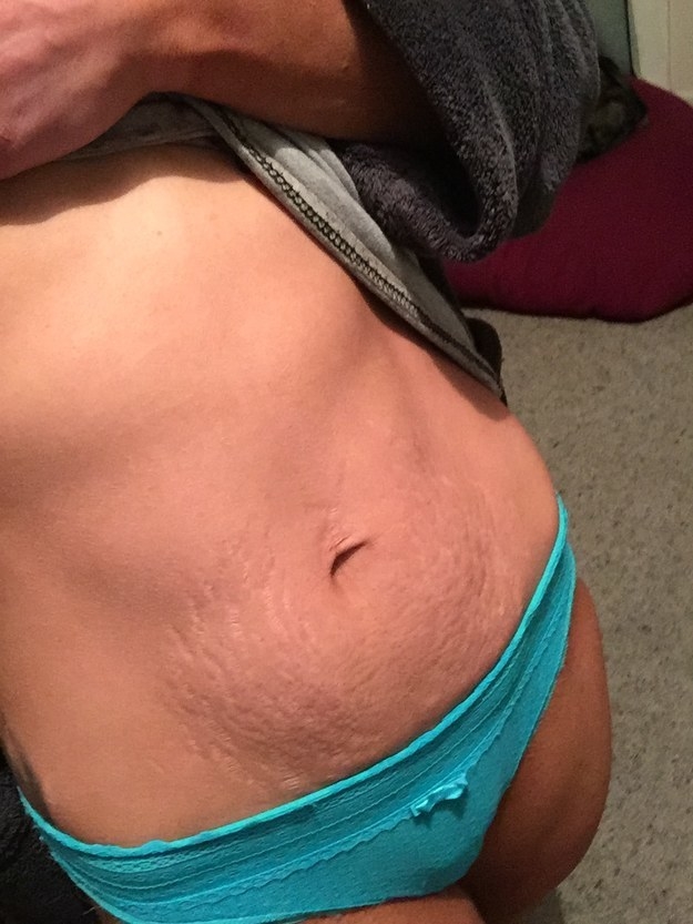 29 Moms Shared Photos Of Their Bodies Right After Giving Birth And