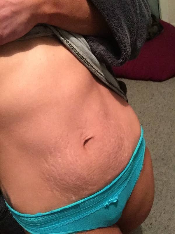 29 Moms Shared Photos Of Their Bodies Right After Giving Birth And