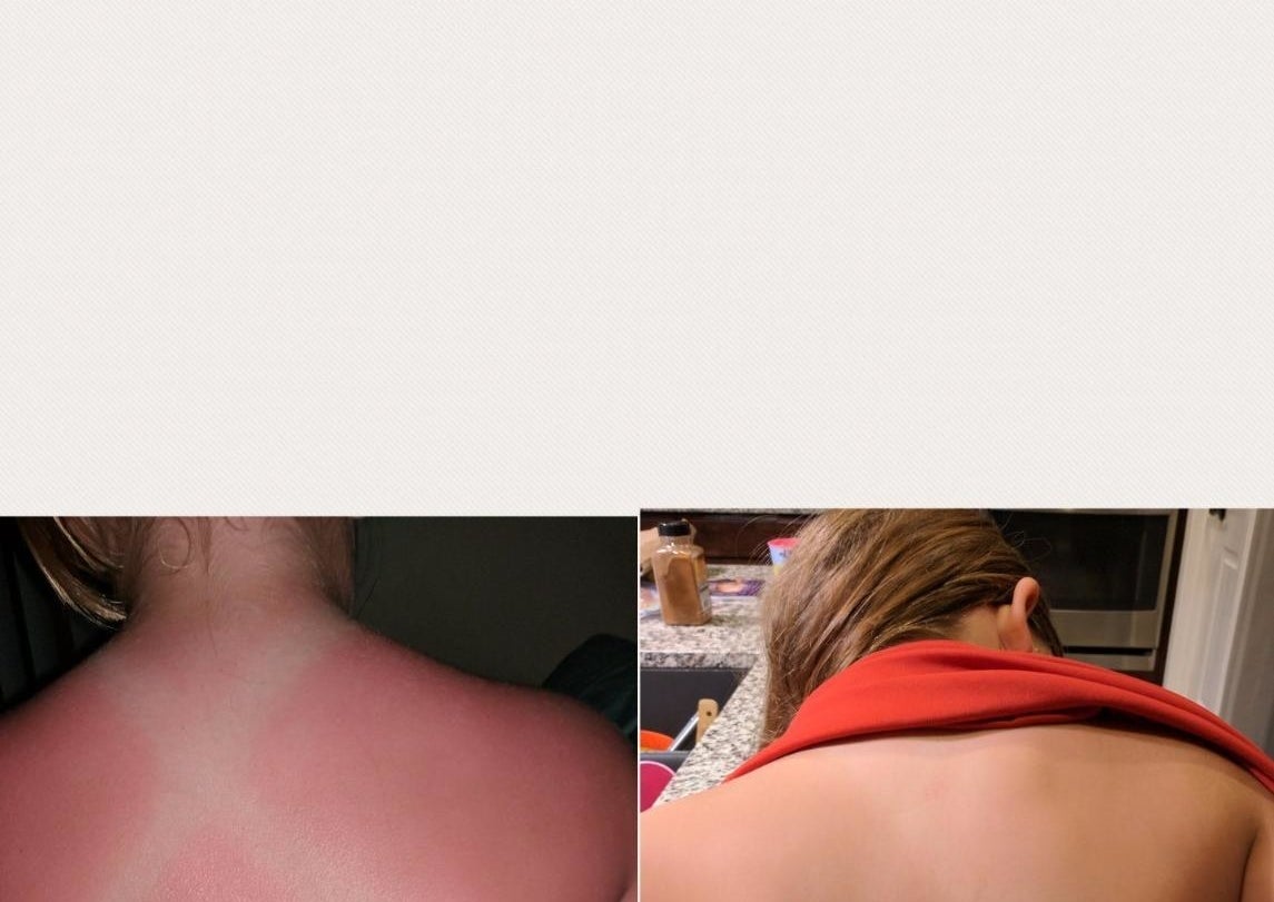 A reviewer&#x27;s back sunburnt in the shape of a bathing suit back on the left / the same back with completely faded burn